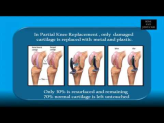 Total Knee Replacement Surgery in Mumbai | Best Orthopedic Surgeon in India - Dr Shailendra Patil